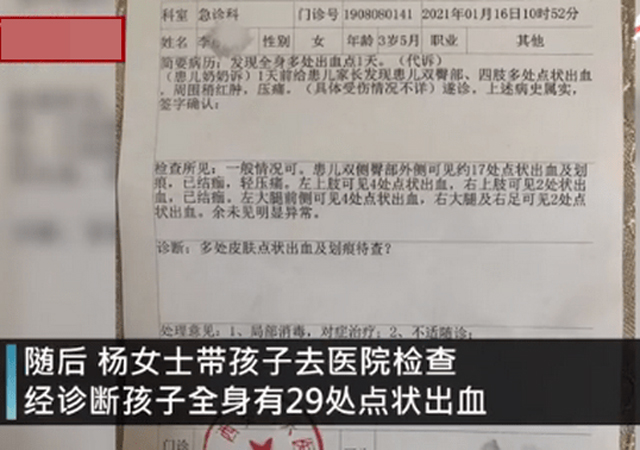幼兒園3歲女童身上現(xiàn)29處針眼2.jpg