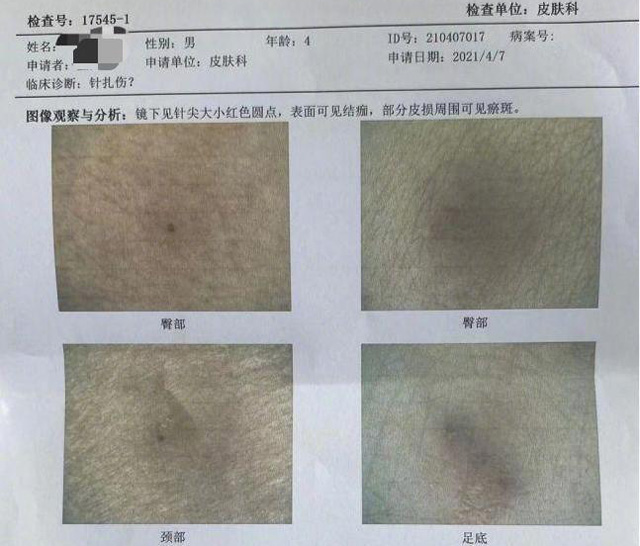 深圳一幼兒園4歲幼童疑遭扎針2.jpg